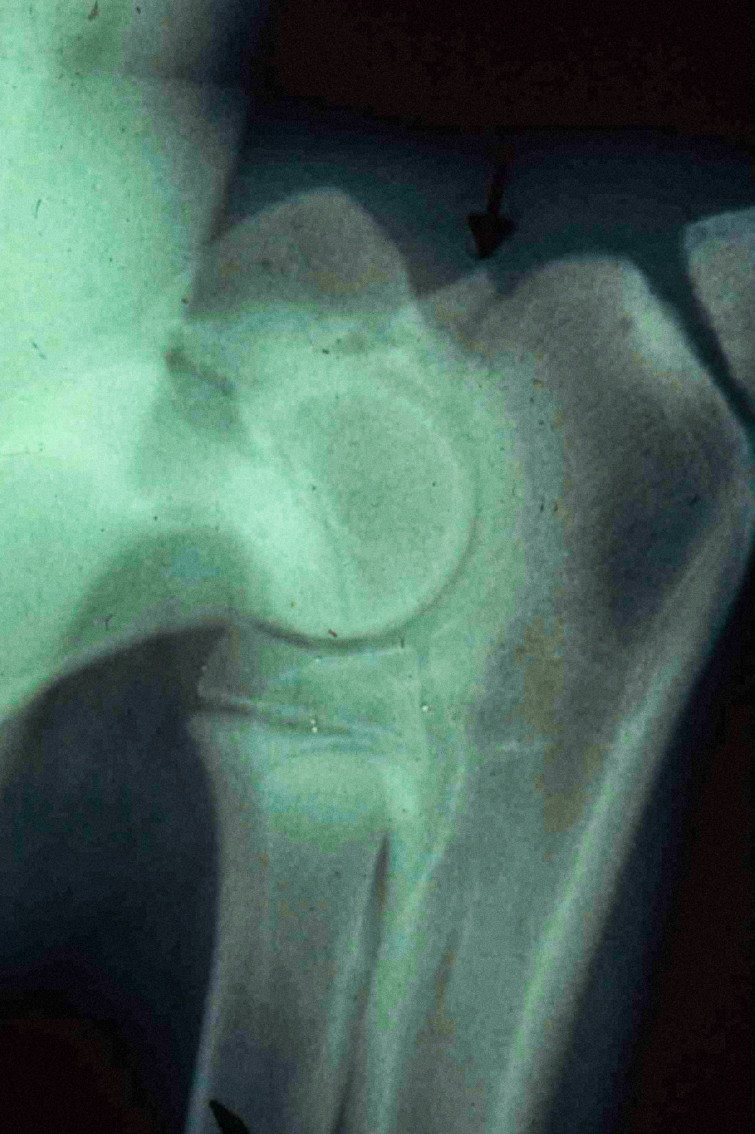 The Bones of Osteoporosis