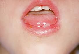Hand Foot Mouth Disease - Some Uncommon Tips