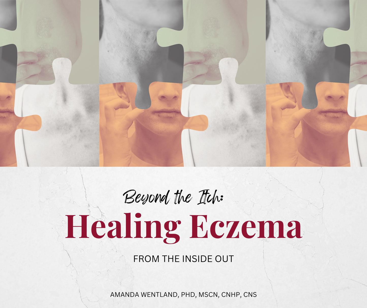 Beyond the Itch: Healing Eczema